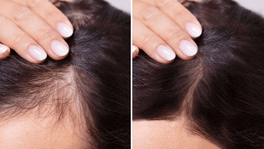 Exosomes for Hair Growth Treatment
